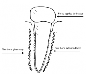 Tooth-Movement-300x2602