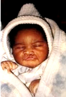 cleft palate